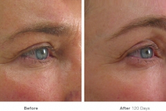 img_template_beforeafter_brow11