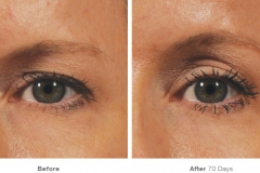 img_template_beforeafter_brow12