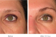 img_template_beforeafter_brow5