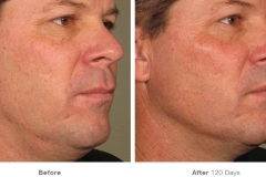 before_after_ultherapy_results_full-face11