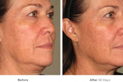 before_after_ultherapy_results_full-face20