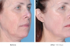 before_after_ultherapy_results_full-face22