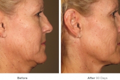 before_after_ultherapy_results_full-face24