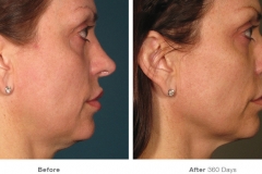 before_after_ultherapy_results_full-face3