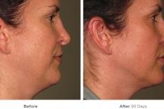 before_after_ultherapy_results_full-face6