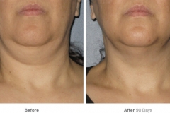 ultherapy-0014-0086w_90day_1tx_neck_gallery