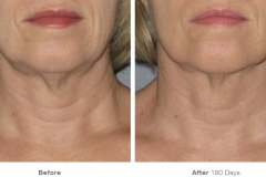 ultherapy-0025-0086w_180day_1tx_neck_gallery