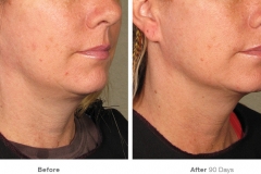 before_after_ultherapy_results_under-chin11