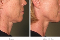 before_after_ultherapy_results_under-chin16