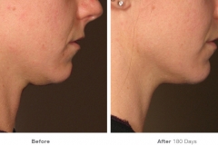 before_after_ultherapy_results_under-chin20