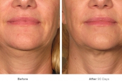 before_after_ultherapy_results_under-chin29