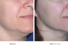 before_after_ultherapy_results_under-chin31