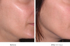 before_after_ultherapy_results_under-chin32