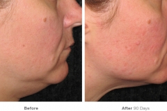 before_after_ultherapy_results_under-chin34