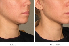 before_after_ultherapy_results_under-chin36