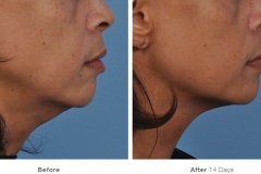 before_after_ultherapy_results_under-chin37